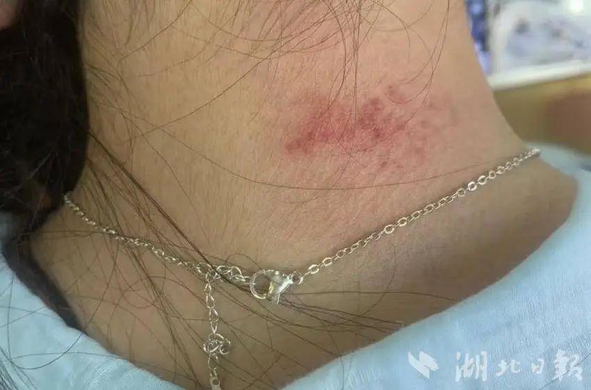 首饰性皮炎” 医生：不要长时间佩戴瓦力游戏试玩女子戴项链被诊断为“(图4)